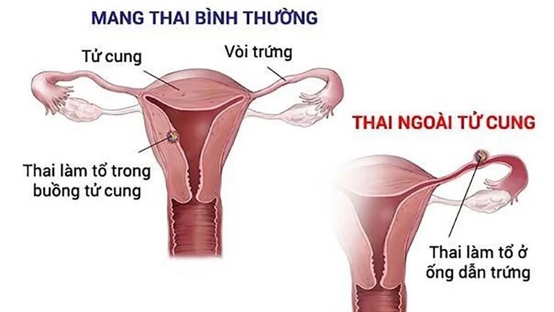 Thai ngoài tử cung có thể gây ra nhiều biến chứng nghiêm trọng, bao gồm cả nguy cơ đe dọa tính mạng