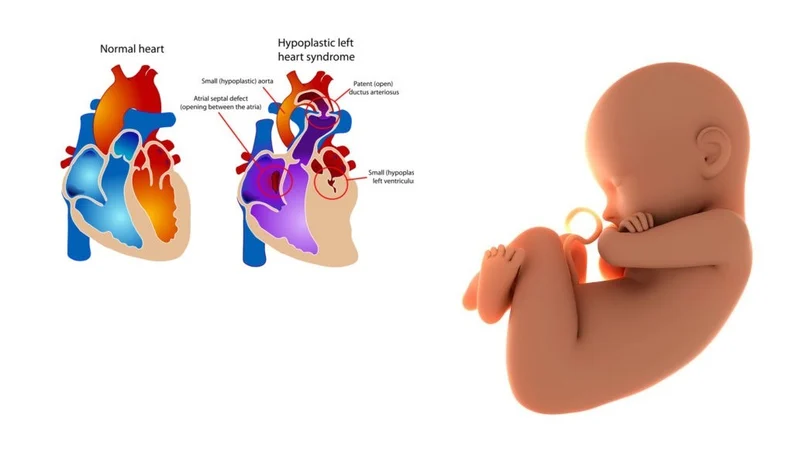 Các dị tật này có thể xuất hiện do sự phát triển không bình thường của tim trong thời kỳ thai nghén